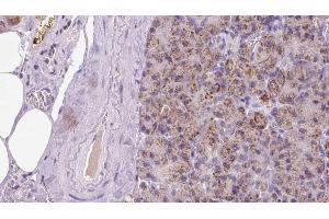 ABIN6273287 at 1/100 staining Human pancreas cancer tissue by IHC-P.