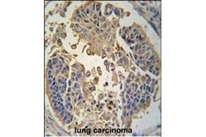 Formalin-fixed and paraffin-embedded human lung carcinoma tissue reacted with RIP3 (RIPK3) antibody (C-term) (ABIN392275 and ABIN2841945) , which was peroxidase-conjugated to the secondary antibody, followed by DAB staining. (RIPK3 antibody  (C-Term))