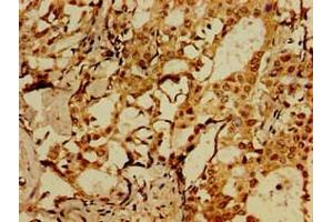 Immunohistochemistry of paraffin-embedded human breast cancer using ABIN7175658 at dilution of 1:100 (SORCS1 antibody  (AA 34-175))
