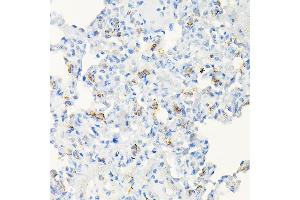 Immunohistochemistry of paraffin-embedded human colon carcinoma using  Rabbit pAb (ABIN6131167, ABIN6136429, ABIN6136430 and ABIN6216480) at dilution of 1:50 (40x lens).