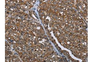 The image on the left is immunohistochemistry of paraffin-embedded Human ovarian cancer tissue using ABIN7191991(PRDM2 Antibody) at dilution 1/25, on the right is treated with synthetic peptide. (PRDM2 antibody)