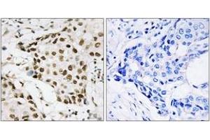 Immunohistochemistry analysis of paraffin-embedded human breast carcinoma, using NPM (Phospho-Thr199) Antibody. (NPM1 antibody  (pThr199))