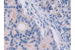 DAB staining on IHC-P; Samples: Human Prostate cancer Tissue