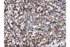 Immunohistochemical staining of paraffin-embedded Carcinoma of Human kidney tissue using anti-NNMT mouse monoclonal antibody. (NNMT antibody)