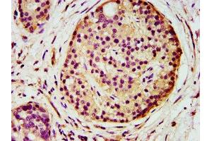 IHC image of ABIN7143720 diluted at 1:500 and staining in paraffin-embedded human pancreatic cancer performed on a Leica BondTM system. (AGPS antibody  (AA 279-400))