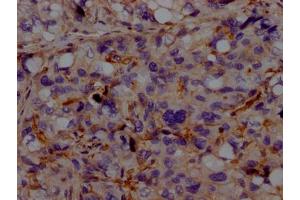 IHC image of ABIN7127322 diluted at 1:100 and staining in paraffin-embedded human liver cancer performed on a Leica BondTM system. (Recombinant ACVRL1 antibody)