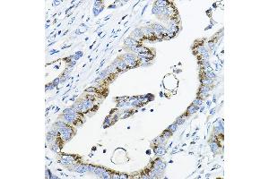 Immunohistochemistry of paraffin-embedded human colon carcinoma using G Rabbit pAb (ABIN6131444, ABIN6140942, ABIN6140944 and ABIN6218180) at dilution of 1:100 (40x lens).