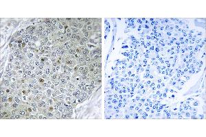 Peptide - +Immunohistochemistry analysis of paraffin-embedded human breast carcinoma tissue, using ETV4 antibody.