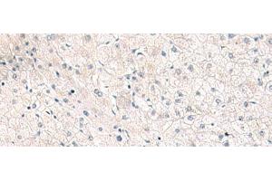 Immunohistochemistry of paraffin-embedded Human liver cancer tissue using FGFR4 Polyclonal Antibody at dilution of 1:25(x200)