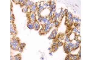 Immunohistochemistry of paraffin-embedded Human liver cancer using GLUD2 Polyclonal Antibody at dilution of 1:100 (40x lens).