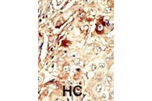 Formalin-fixed and paraffin-embedded human cancer tissue reacted with the primary antibody, which was peroxidase-conjugated to the secondary antibody, followed by AEC staining. (WEE1 antibody  (AA 144-173))