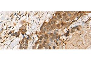 Immunohistochemistry of paraffin-embedded Human thyroid cancer tissue using HEATR9 Polyclonal Antibody at dilution of 1:110(x200) (C17orf66 antibody)