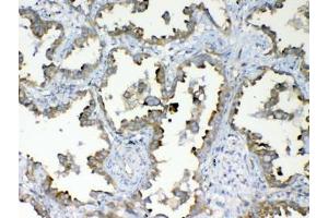 IHC testing of FFPE human lung cancer tissue with DYNLT1 antibody at 1ug/ml. (DYNLT1 antibody)