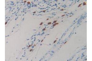 IHC-P analysis of Human Rectum Cancer Tissue, with DAB staining. (Resistin antibody  (AA 17-108))