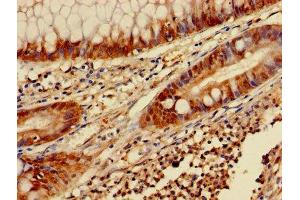 Immunohistochemistry of paraffin-embedded human colon cancer using ABIN7153453 at dilution of 1:100 (Galectin 3 antibody  (AA 2-250))
