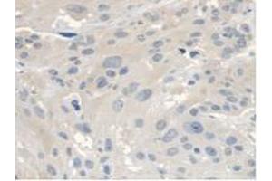 IHC-P analysis of Human Esophagus Cancer Tissue, with DAB staining. (ANTXR2 antibody  (AA 34-318))