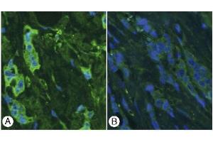 Immunohistochemistry image of Thymosin ß4 staining in paraffn sections of breast cancer tissue.