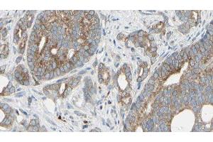 ABIN6276332 at 1/100 staining Human prostate tissue by IHC-P. (NEFL antibody  (N-Term))