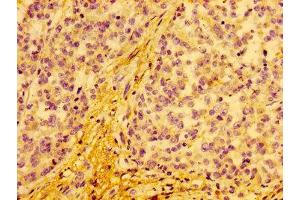 IHC image of ABIN7149142 diluted at 1:100 and staining in paraffin-embedded human colon cancer performed on a Leica BondTM system. (COX15 antibody  (AA 1-67))