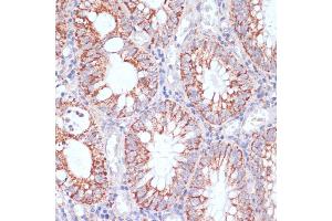 Immunohistochemistry of paraffin-embedded human colon carcinoma using HIGD1A antibody (ABIN7267642) at dilution of 1:100 (40x lens). (HIGD1A antibody  (AA 1-93))