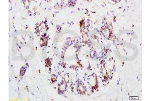 Formalin-fixed and paraffin embedded human breast carcinoma labeled with Anti-CCR3 Polyclonal Antibody, Unconjugated (ABIN738651) at 1:200 followed by conjugation to the secondary antibody and DAB staining. (CCR3 antibody  (AA 251-355))