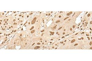 Immunohistochemistry of paraffin-embedded Human esophagus cancer tissue using ZNF274 Polyclonal Antibody at dilution of 1:35(x200)