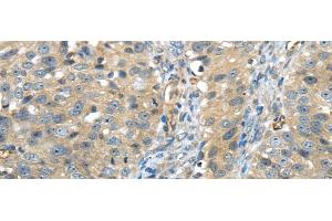 Immunohistochemistry of paraffin-embedded Human breast cancer using ISM2 Polyclonal Antibody at dilution of 1/45 (Isthmin 2 antibody)