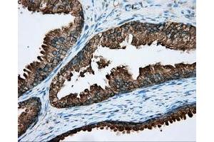 Immunohistochemical staining of paraffin-embedded Carcinoma of liver tissue using anti-RDH11 mouse monoclonal antibody. (RDH11 antibody)