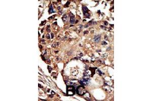Formalin-fixed and paraffin-embedded human cancer tissue reacted with PACSIN1 polyclonal antibody  , which was peroxidase-conjugated to the secondary antibody, followed by DAB staining. (PACSIN1 antibody  (N-Term))