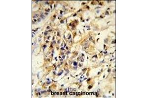 Formalin-fixed and paraffin-embedded human breast carcinoma reacted with RPGRIP1 Antibody (Center), which was peroxidase-conjugated to the secondary antibody, followed by DAB staining. (RPGRIP1 antibody  (AA 530-557))
