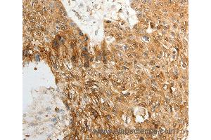 Immunohistochemistry of Human ovarian cancer using TENM3 Polyclonal Antibody at dilution of 1:50 (TENM3 antibody)