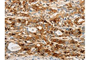 The image on the left is immunohistochemistry of paraffin-embedded Human gastic cancer tissue using ABIN7130484(OASL Antibody) at dilution 1/20, on the right is treated with fusion protein. (OASL antibody)