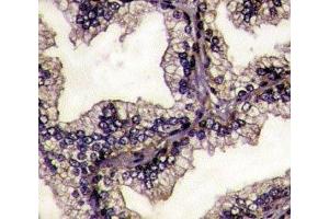 IHC analysis of FFPE prostate carcinoma tissue stained with Lactoferrin antibody.