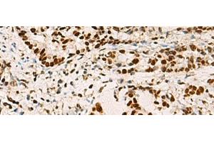 Immunohistochemistry of paraffin-embedded Human cervical cancer tissue using ELF5 Polyclonal Antibody at dilution of 1:70(x200)