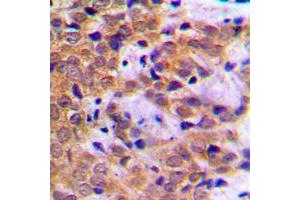 Immunohistochemical analysis of STAT5A (pS780) staining in human breast cancer formalin fixed paraffin embedded tissue section.