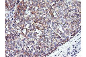 Immunohistochemical staining of paraffin-embedded Adenocarcinoma of Human ovary tissue using anti-NMT2 mouse monoclonal antibody.