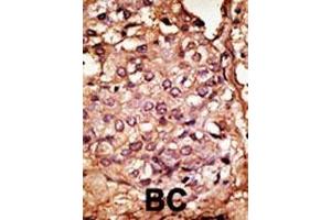 Formalin-fixed and paraffin-embedded human cancer tissue reacted with the primary antibody, which was peroxidase-conjugated to the secondary antibody, followed by AEC staining. (CCBP2 antibody  (AA 54-84))