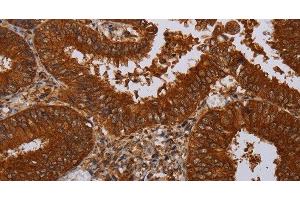Immunohistochemistry of paraffin-embedded Human colon cancer tissue using MFAP3L Polyclonal Antibody at dilution 1:50 (MFAP3L antibody)