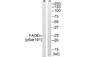 Immunohistochemistry analysis of paraffin-embedded human breast carcinoma tissue, using FADD (Phospho-Ser191) antibody. (FADD antibody  (pSer191))