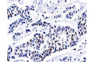 IHC testing of invasive ductal carcinoma stained with progesterone receptor antibody (PR501). (Progesterone Receptor antibody)