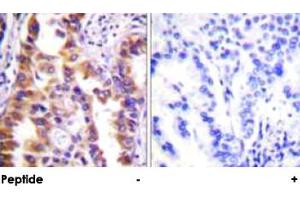 Immunohistochemical analysis of paraffin-embedded human lung carcinoma tissue using TSC2 polyclonal antibody . (Tuberin antibody)