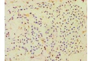 Immunohistochemistry of paraffin-embedded human breast cancer using ABIN7151000 at dilution of 1:100 (CBLC antibody  (AA 245-474))