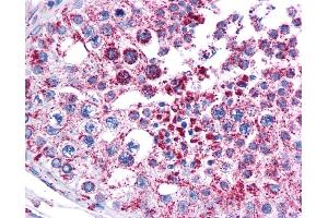 Immunohistochemistry (IHC) image for anti-Melanoma Antigen Family A, 3 (MAGEA3) (Middle Region) antibody (ABIN2782498) (MAGEA3 antibody  (Middle Region))