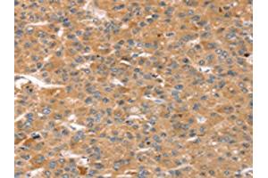 The image on the left is immunohistochemistry of paraffin-embedded Human liver cancer tissue using ABIN7128752(CAPN7 Antibody) at dilution 1/20, on the right is treated with fusion protein.