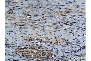 Formalin-fixed and paraffin embedded human colon carcinoma labeled with Rabbit Anti GM-CSF Polyclonal Antibody, Unconjugated (ABIN704156) at 1:200 followed by conjugation to the secondary antibody and DAB staining (GM-CSF antibody  (AA 65-144))