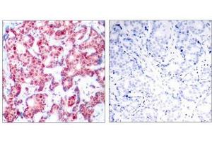 Immunohistochemical analysis of paraffin-embedded human breast carcinoma tissue using GATA1(Phospho-Ser142) Antibody(left) or the same antibody preincubated with blocking peptide(right). (GATA1 antibody  (pSer142))