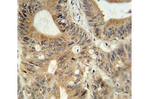 ABCC3 antibody immunohistochemistry analysis in formalin fixed and paraffin embedded human colon carcinoma. (ABCC3 antibody  (AA 899-925))
