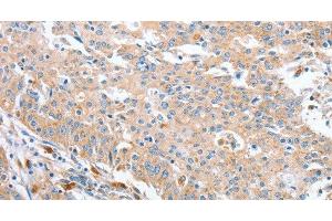 Immunohistochemistry of paraffin-embedded Human gastric cancer using WNT3A Polyclonal Antibody at dilution of 1:40 (WNT3A antibody)