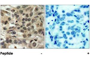 Imunohistochemical analysis of paraffin-embedded human breast carcinoma tissue using CDC25C polyclonal antibody . (CDC25C antibody)