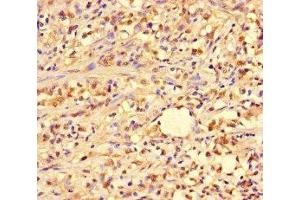 Immunohistochemistry of paraffin-embedded human gastric cancer using ABIN7144964 at dilution of 1:100 (PIF1 antibody  (AA 125-360))